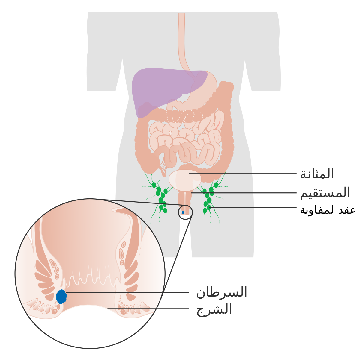 iagram_showing_stage_1_anal_cancer_CRUK_189-ar.svg.png