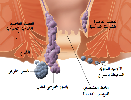 Internal_and_external_hemorrhoids-ar.png