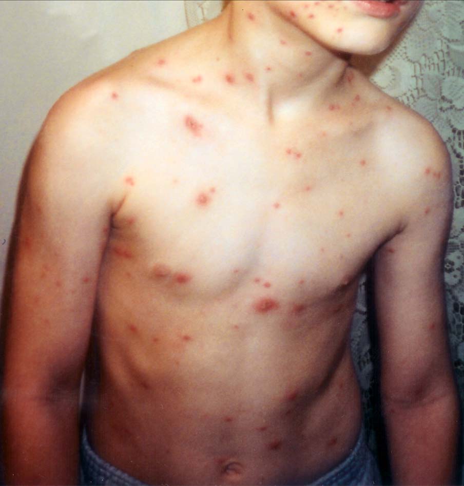 Child_with_chickenpox.jpg