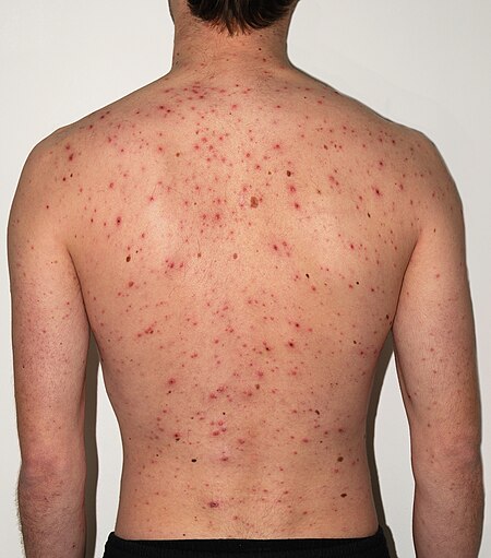 chickenpox-adult-back_1703140323.jpg